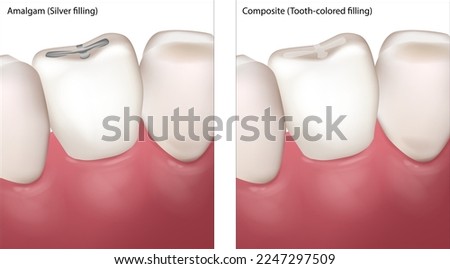 Dental Filling Procedure. Amalgam Silver filling and Composite Tooth colored filling.