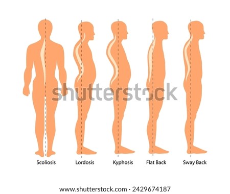 Medical illustration of spinal deformity types: scoliosis, lordosis and kyphosis, Sway back. Body posture defect. Infographics of spine diseases.