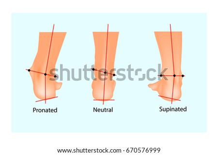 Vector illustration of the normal human foot and the foot with pronation and supination. Foot Biomechanics. Orthodic.