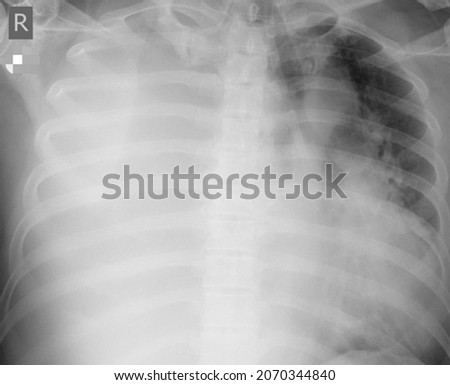 masive pleural effusion chest x ray Photo stock © 
