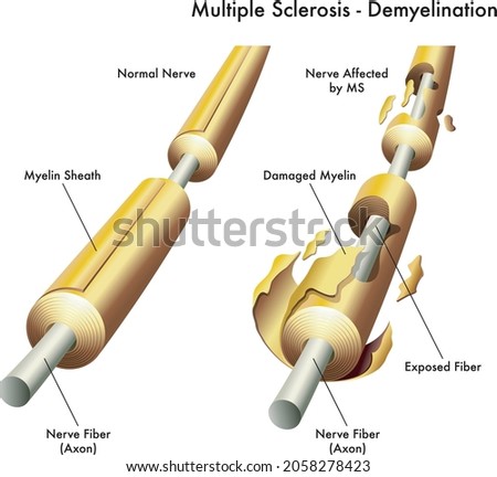 Medical illustration comparing healthy nerve with labelled one with damage caused by multiple sclerosis.