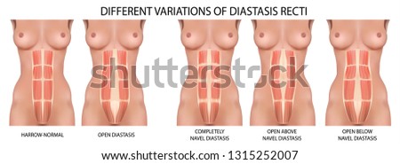 Diastasis recti also known as abdominal separation.