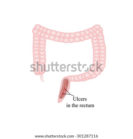 An Ulcer In The Rectum. Ulcers In The Intestines. Vector Illustration ...