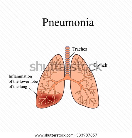 Pneumonia. The Anatomical Structure Of The Human Lung. Inflammation Of ...