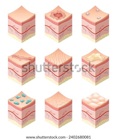Skincare medical concept. Set of problems of different skin types in cross-section of human skin horizontal layers structure. Anatomy illustrative model layers of skin
