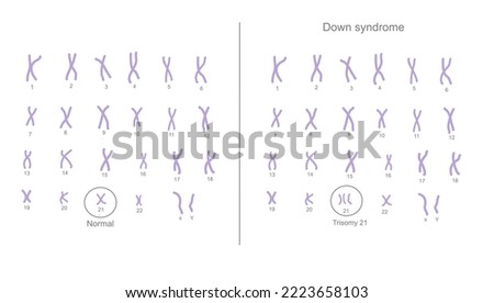 The chromosome 21 are changed the copy number from normal (2 copies) to abnormal (extra) chromosome (3 copies) that call Trisomy 21: Down syndrome