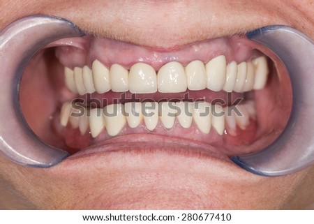 teeth in the mouth