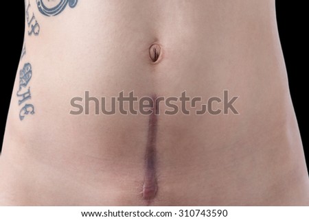 A woman with a tattoo\'s scar from a c-section birth on a black background.