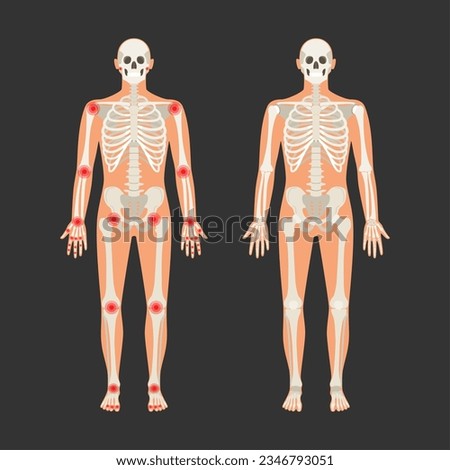 Human skeleton with pain points in rheumatoid arthritis. Men anatomy illustration with a body silhouette. Vector isolated flat of skull and bones in body. Skeleton with injury from arthritis