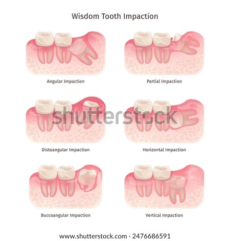 Wisdom tooth. Wisdoms teeth dental problem, molar extraction root canal bone or gum pain surgery treatment remove teeths dentist x ray infographic, swanky vector illustration