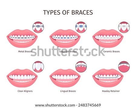 Braces types. Dental bracket teeth retainer type, metalic plastic ceramic invisible sapphire brace aesthetic tooth mouth, orthodontic aligner infographic swanky vector illustration