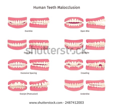 Malocclusion. Tooth open bite protruding mouth jaw problem orthodontics infographic, overbite underbite human teeth anatomy dental structure, dentistry swanky vector illustration