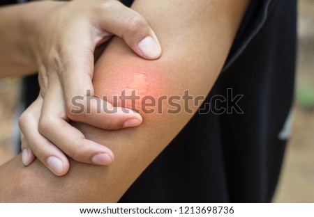 Close-up of bee sting stuck in human skin. Imagine de stoc © 