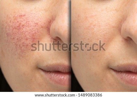 Before and after laser treatment for rosacea, couperose. Successful intervention Stockfoto © 