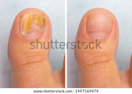 Before and after topical antifungal treatment is seen in the big toe of a person suffering from Onychomycosis, a fungal infection causing yellowing of the toenail. Foto d'archivio © 