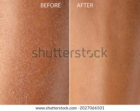 Macro of dry woman skin before and after moisturizing treatment. Detail with and without desquamation and exfoliation due to dehydration. Skincare concept Foto d'archivio © 