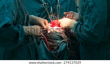 Hands of a team of neurosurgeons are seen performing brain surgery to remove a tumor.