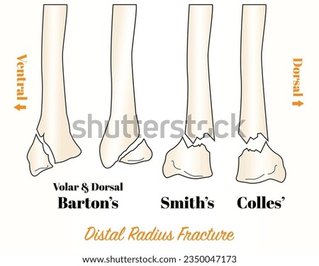 Different types of distal radius fracture _ Colles' fracture, Smith's Fracture, Barton's fracture