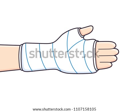 Broken arm, bone fracture, orthopedic plaster cast vector isolated.