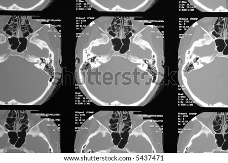 Multiples magnetic resonance image of brain and cranium, MRI