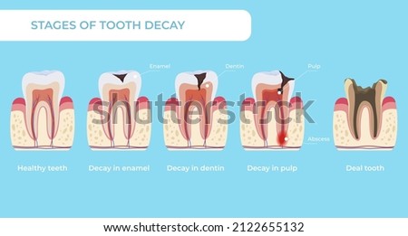 Stage tooth decay infographic medical educational scheme names diagnosis vector flat illustration. Teeth formation steps, from healthy to deal, forming dental plaque caries in enamel, dentin and pulp Stock foto © 