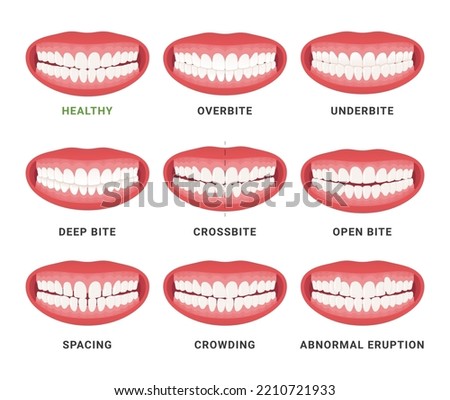 Human mouth jaws medical bad bite and healthy scheme with names set vector flat illustration. Orthodontist anatomical surgery correction dentistry disease overbite underbite crossbite spacing