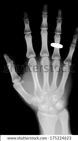 hand x ray with a wedding ring