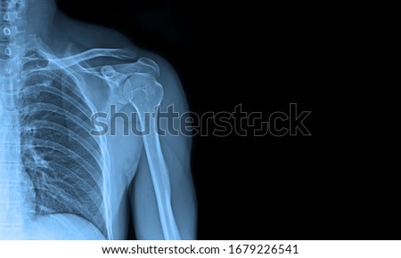 x-ray images shoulder joint to see injuries of tendons and bones for a medical diagnosis. Foto d'archivio © 
