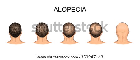 illustration of male head, alopecia