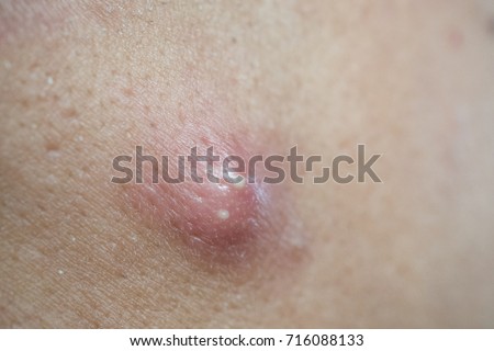 pimple on human skin macro stock photo image of papule 28627564 free photos pimple avopix pimple on human skin macro stock photo image of papule 28627564 free photos pimple avopix