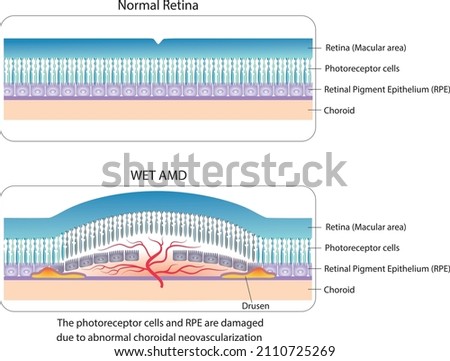Simple illustration of normal retina and Wet AMD (Age related Macular Diseases). 