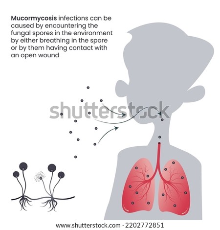 Mucormycosis black fungus infection in the lungs through inhaled spores