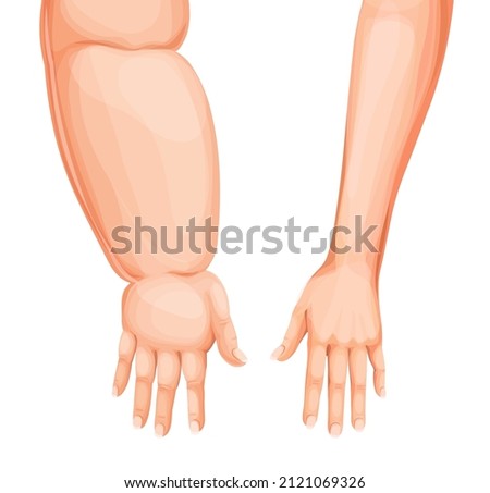 Edema swollen hand or arm. Lymphedema, eodema disease vector. Cartoon human body forearms and hands, swollen and healthy arms, fingers, wrists and elbows comparison Stockfoto © 