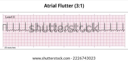 ECG Atrial Flutter (3:1) - 8 Second ECG Paper - Electrocardiography Vector Medical Illustration