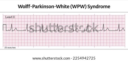 ECG Wolff-Parkinson-White (WPW) Syndrome - 8 Second ECG Paper - Vector Medical Illustration