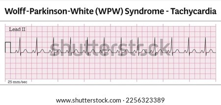 ECG Wolff-Parkinson-White (WPW) Syndrome and Tachycardia - 8 Second ECG Paper - Vector Medical Illustration