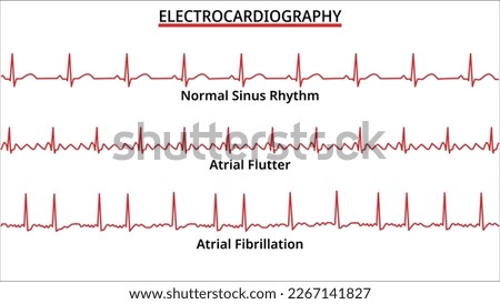 Set of ECG Common Abnormalities - Atrial Flutter vs Atrial Fibrillation - Normal Sinus Rhythm - Electrocardiography Vector Medical Illustration