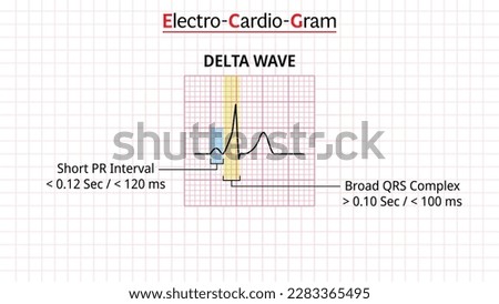 Delta Wave - ECG Morphology - Electrocardiogram - Vector Illustration