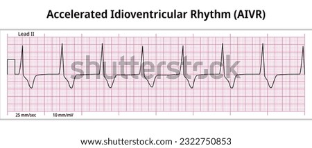 ECG Accelerated Idioventricular Rhythm - 8 Second ECG Paper - Electrocardiography Medical Vector Illustration