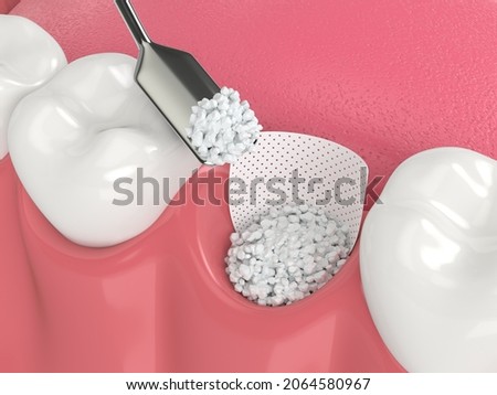 3D render of dental bone grafting with bone biomaterial and membrane over white background. Jaw bone augmentation concept. Foto stock © 