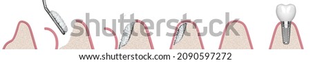 3D render of dental bone grafting preparing to implant installation Foto d'archivio © 