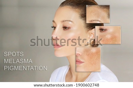 Dark spots, freckles,hyperpigmentation(melasma or chloasma),concept - skin lightening, skin whitening, fruit acids,AHA, Skin Brightening	