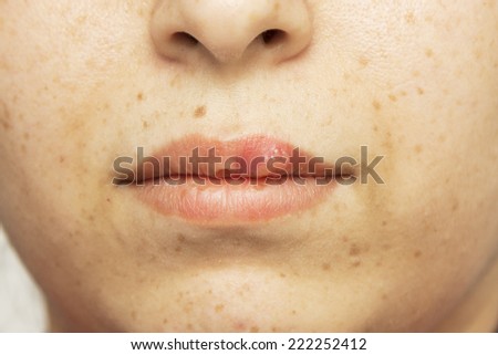 herpes oral cold sore blisters fever blisters on the lips- herpes simplex