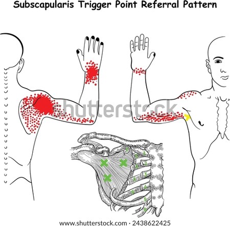 subscapularis trigger point referral pattern vector Diagram