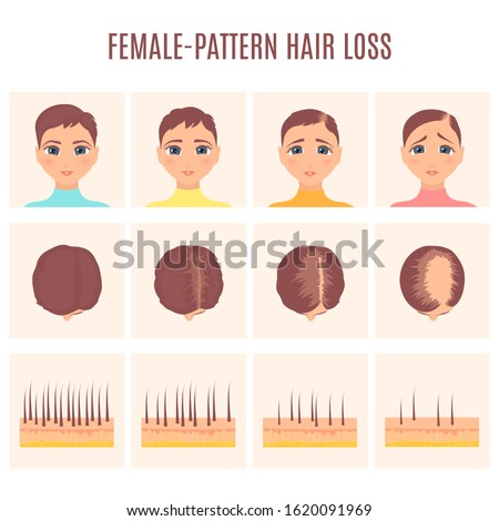 Female pattern hair loss set. Stages of baldness in women. Treatment result in front and top view. Number of follicles on scalp in each step. Alopecia infographic medical vector illustration.