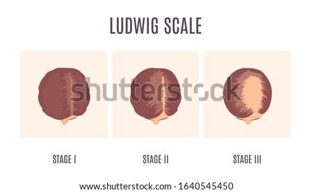 Female-pattern hair loss by Ludwig scale. 3 stages of baldness in women. Classification of alopecia shown on a head in top view. Beauty and health care concept. Medical vector illustration.