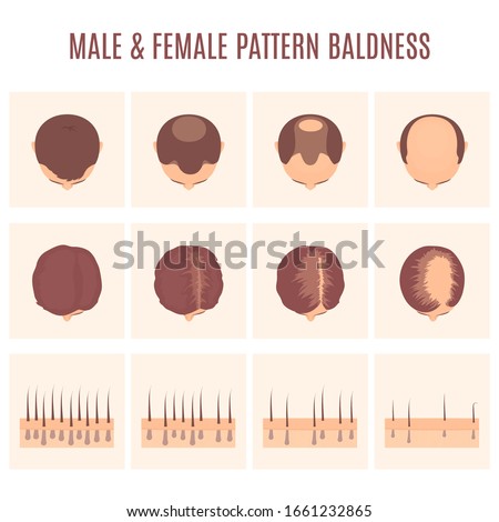 Male and female-pattern hair loss set. Stages of baldness in men and women. Head in top view. Number of follicles on scalp in each step. Alopecia infographic medical vector illustration.