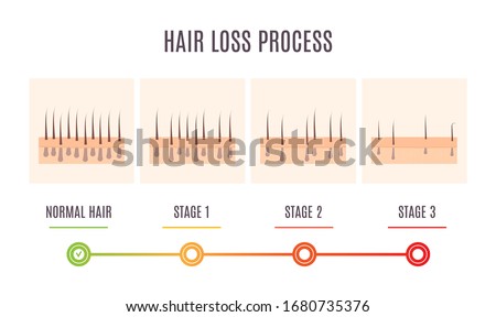 Hair loss process infographic of scalp close up with receding hair follicles. Skin cross-section medical diagnostics diagram. Alopecia treatment and transplantation concept. Vector illustration.