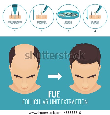 Male hair loss treatment with follicular unit extraction. Stages of FUE procedure. Alopecia infographic medical design template for transplantation clinics and diagnostic centers. Vector illustration.