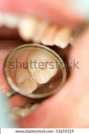 Photo of dental exam, the molar tooth in dental mirror